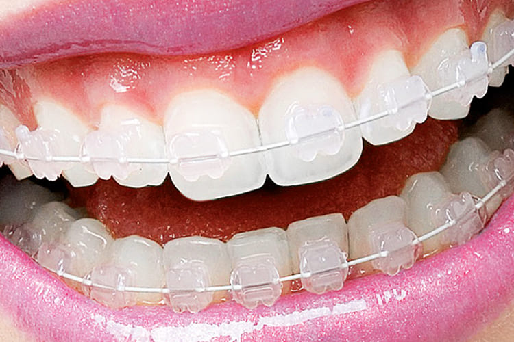 Transparent braces